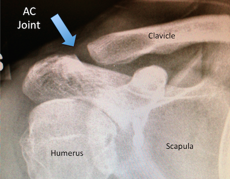 AC Joint X-ray
