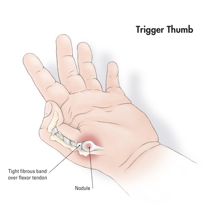 trigger thumb