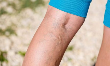 crossfit Varicose Veins