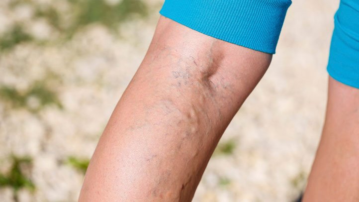 crossfit Varicose Veins