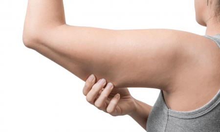 liposuction arms