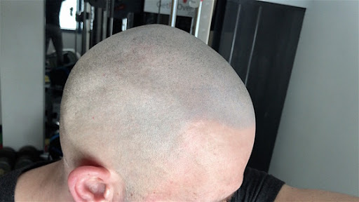scalp micro pigmentation