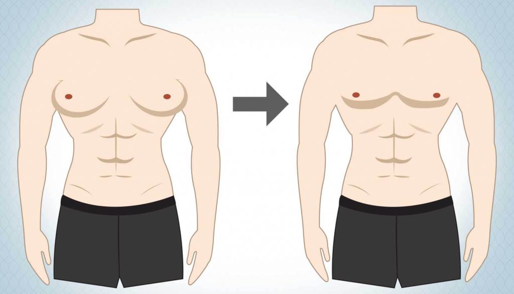 Gynecomastia