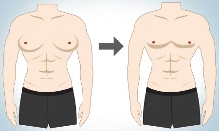 Gynecomastia