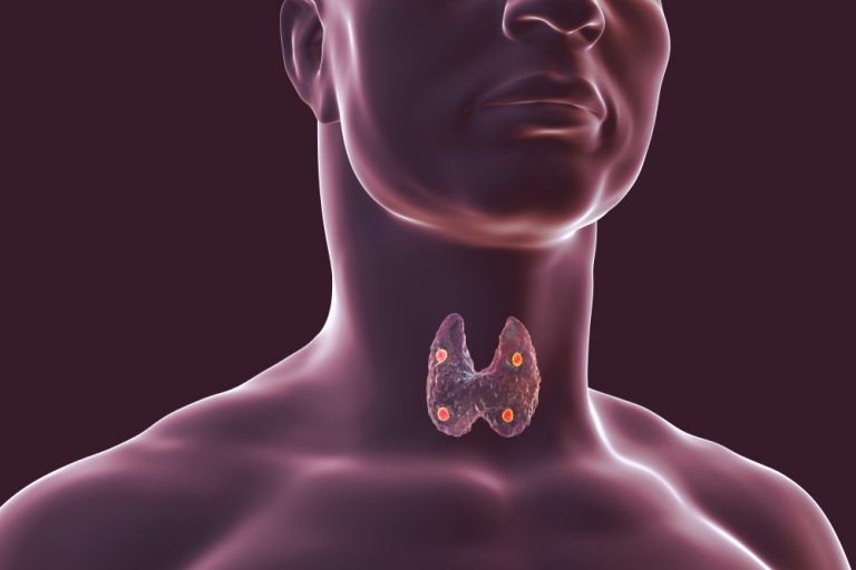 throat Hyperparathyroidism