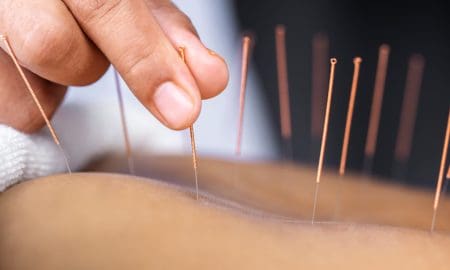 accupuncture